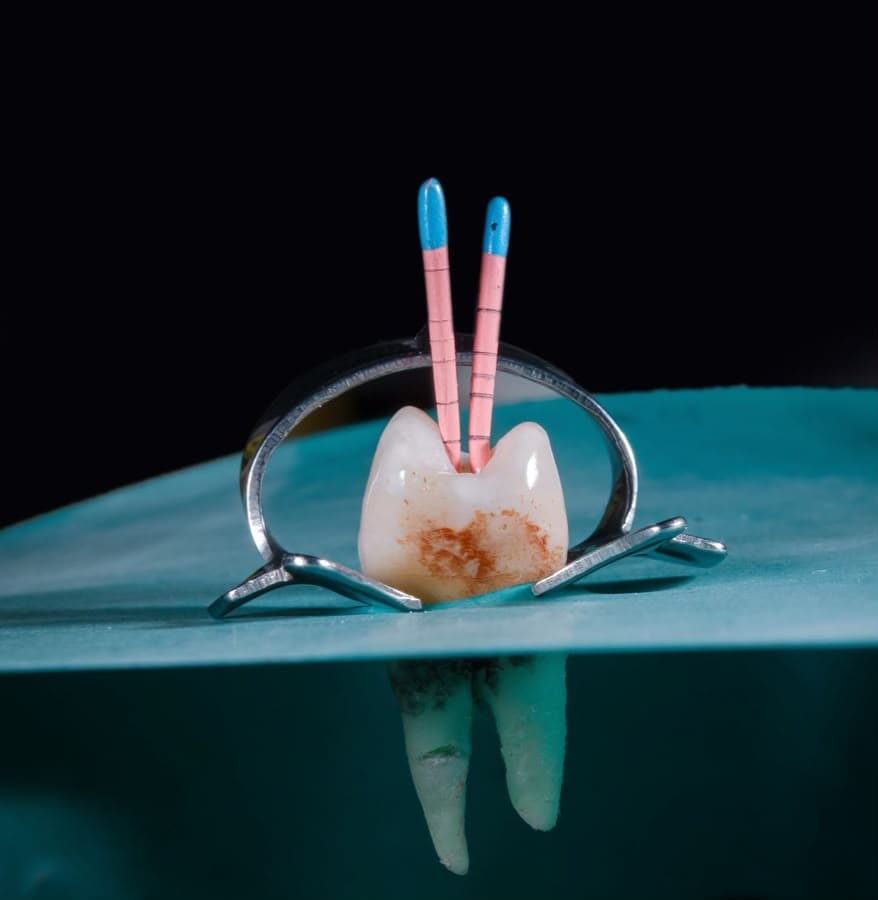 Root Canal Treatment (RCT)