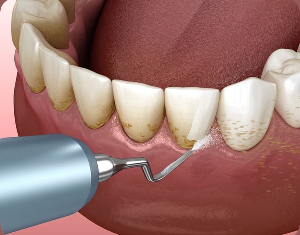 Scaling & Gum Treatment